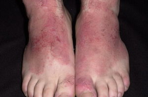 аллергия на ногах