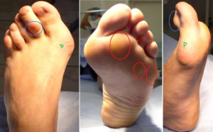лечение шишки на ноге на подъеме