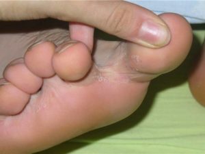 болезненное образование между пальцами ног