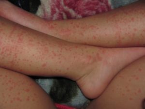 аллергия на ногах
