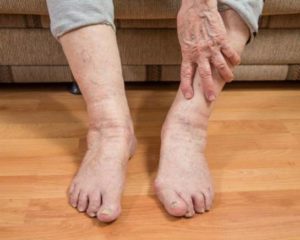 лечение судорог ног 