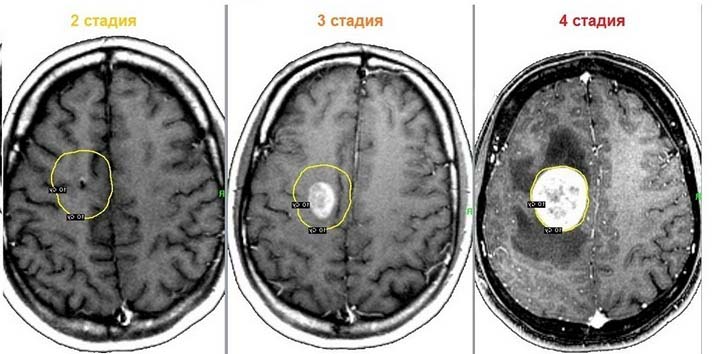 Глиома головного мозга - причины, классификация, лечение