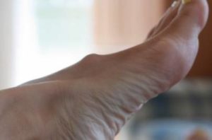 Симптомы и лечение шишки на ноге на подъеме