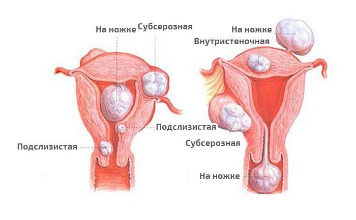 классификация опухолей матки
