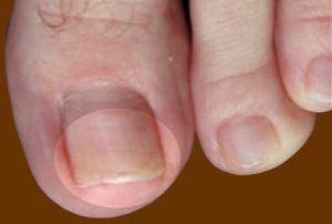 Как быстро вылечить грибок ногтей