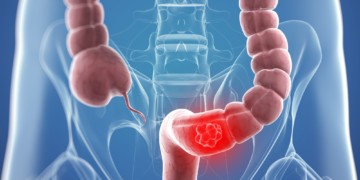 Рак тонкого кишечника: признаки и симптомы на разных стадиях