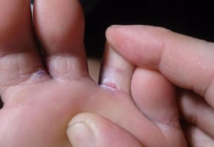 опрелости между пальцами ног