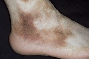 коричневые пятна на ногах