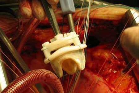 протезирование клапанов сердца