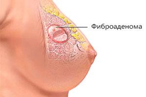 Листовидная фиброаденома молочной железы - причины, диагностика, лечение