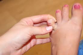 болезненное образование между пальцами ног