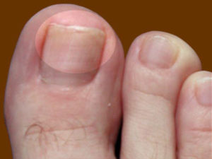 грибок ногтей на ногах