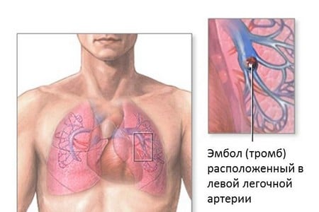 тромб в легочной артерии