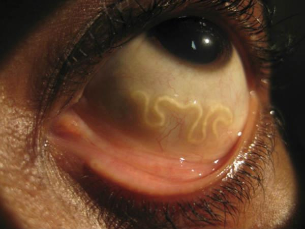 паразиты в глазах человека