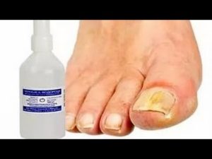 Лечение грибка ногтей перекисью водорода