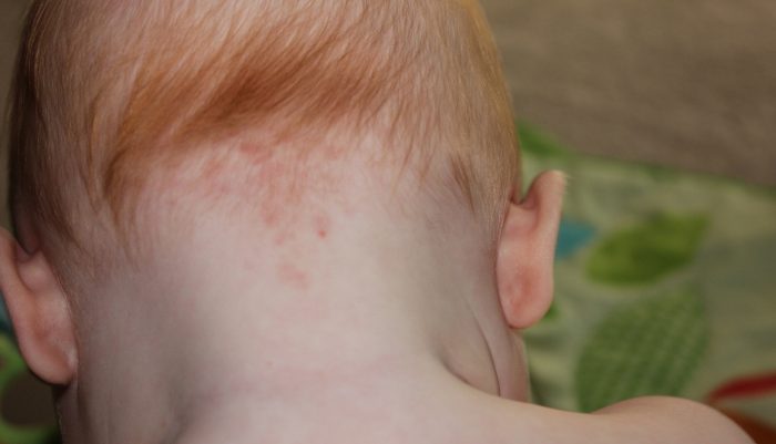  аллергические проявления на коже