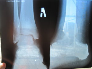 Сколько срастается перелом ноги в голеностопе
