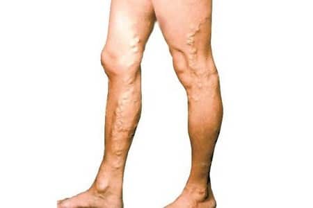 Ноги с варикозной болезнью