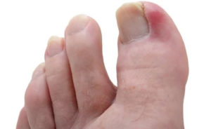 лечение панариция на пальце ноги