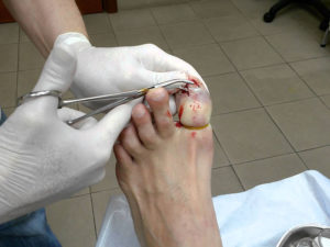 удаление ногтя на ноге
