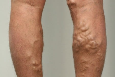 Ноги с варикозом
