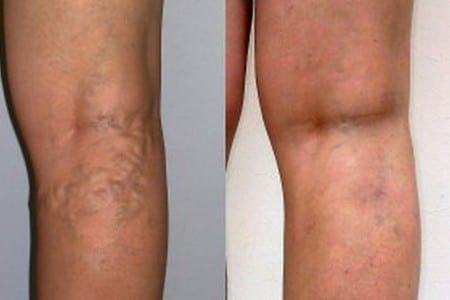 Нога до и после процедуры