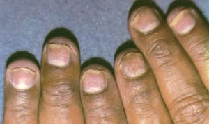 Как правильно отличить псориаз или грибок ногтей