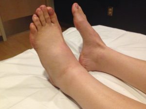 Причины припухлости ноги ниже колена