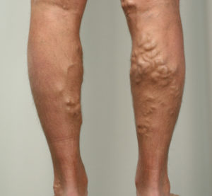 профилактика варикозного расширения вен на ногах