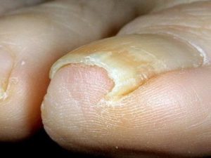 средства против грибка ногтей на ногах
