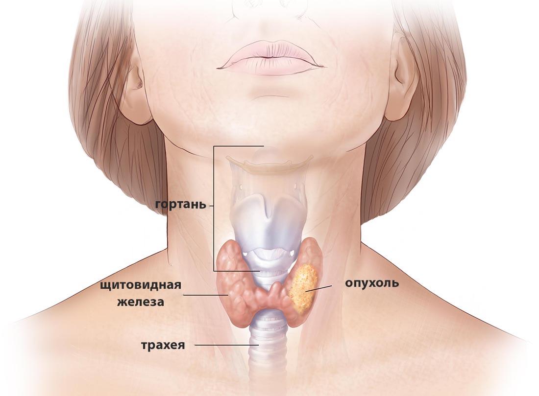 Amenorrea por tiroides