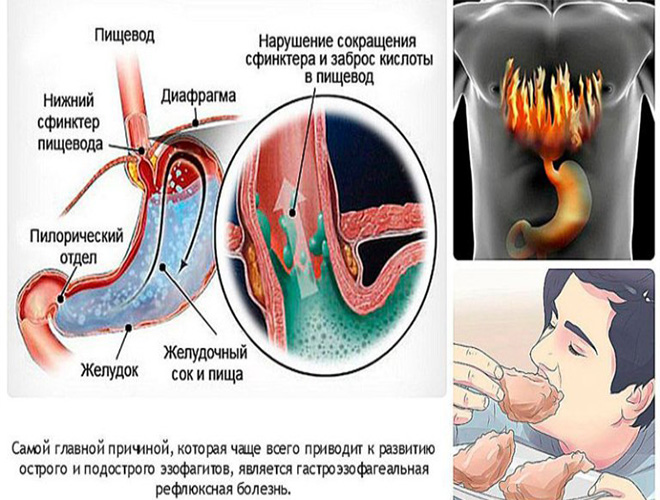 Расслабляется сфинктер. Гастроэзофагеальная рефлюкс болезнь. Гастроэзофагеальный рефлюкс этиология.